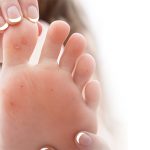 Eerste hulp bij eelt en likdoorns