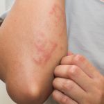 Huiduitslag: verschillende soorten