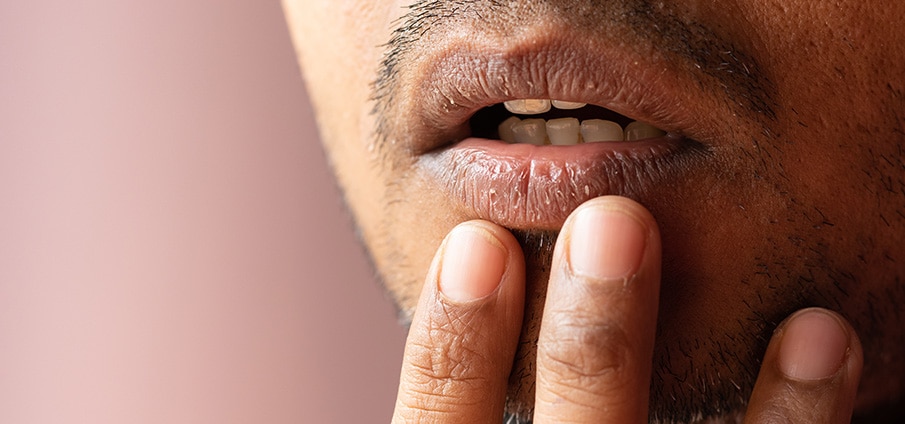 Droge lippen: zo maak je je schrale lippen weer zacht Droge lippen: zo maak je je schrale lippen weer zacht
